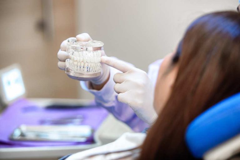 Cinco claves que debes conocer antes de ponerte implantes dentales